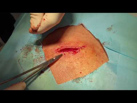 Cyst Removal by Jacksonville Skin Cancer Specialists