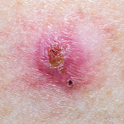 basal-cell-carcinoma-jacksonville-th
