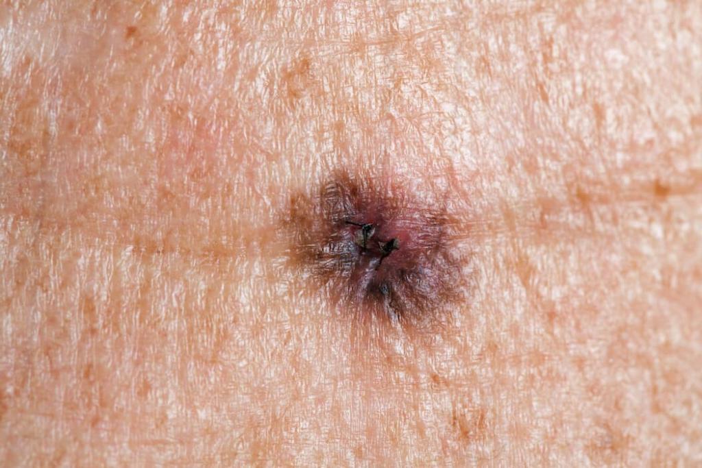 melanoma-jacksonville-picmelanoma-jacksonville-pic