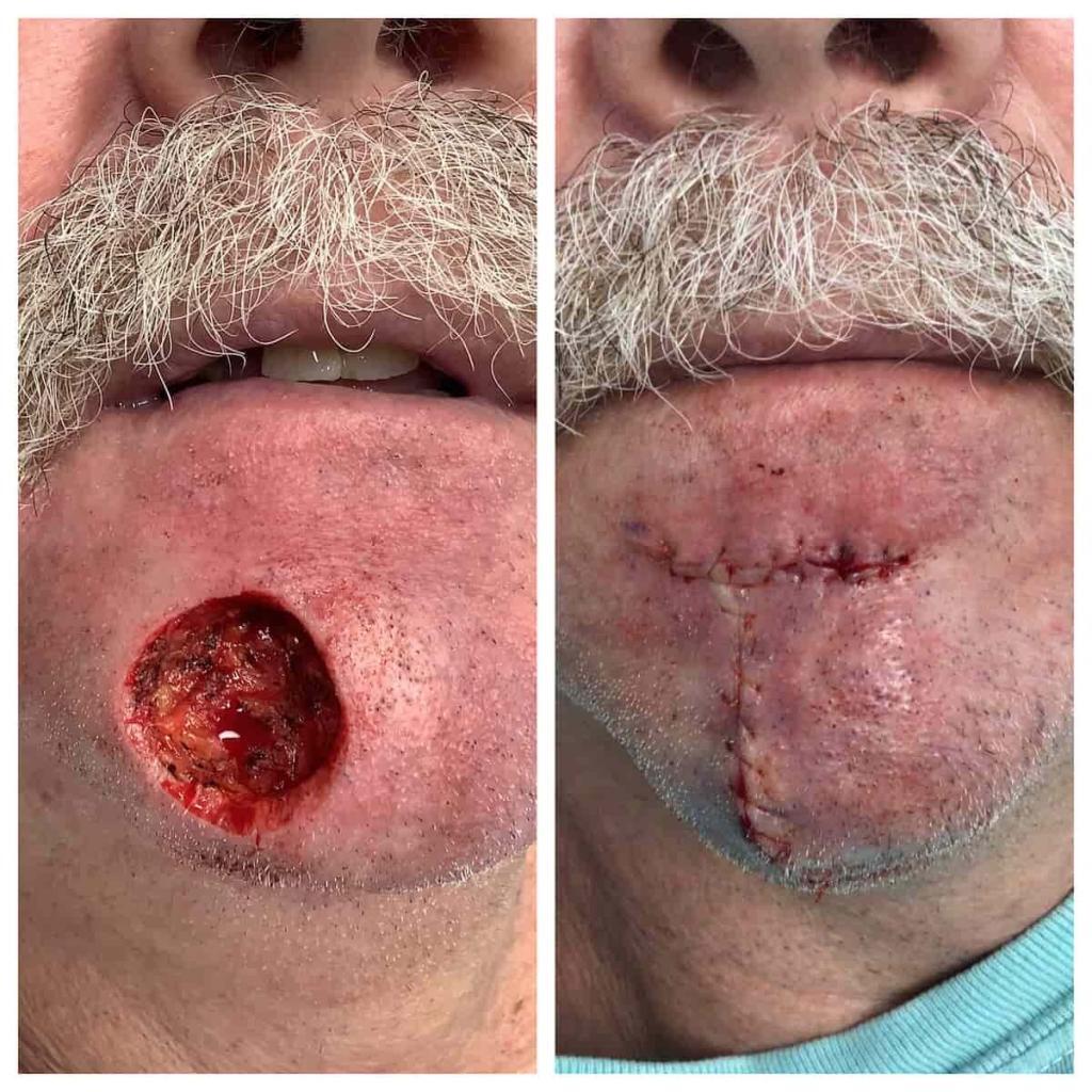 mohs-reconstruction (1)