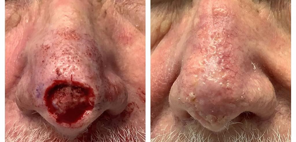 mohs-surgery-on-nose-before-and-after